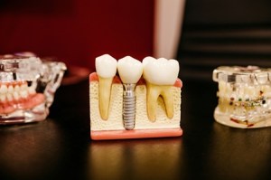 A model of a jaw showing three teeth on a dark wood table with a red wall in the background. The middle is a dental implant.