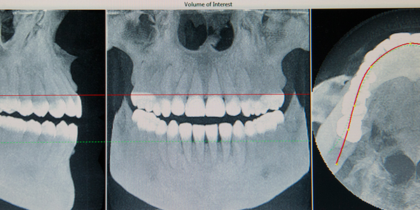 X-Rays