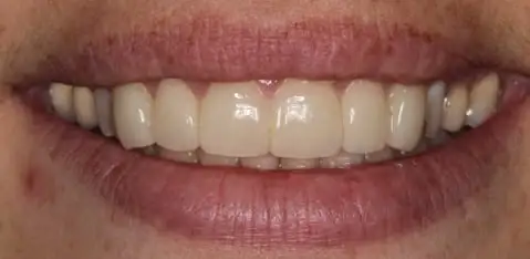Before and After Case 4