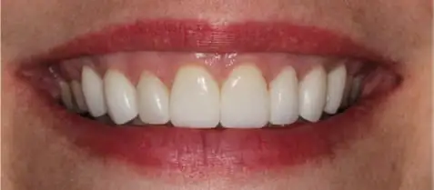 Before and After Case 5