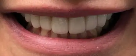 Before and After Case 6