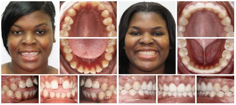 Invisalign case study