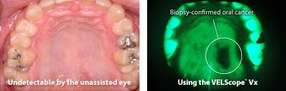 Example of VELscope imagery