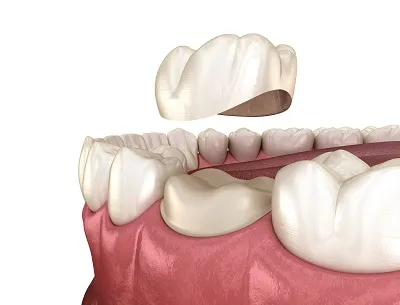 illustration of a dental crown being placed