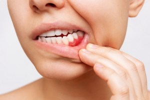 A person pulling down their bottom lip to show inflamed gums