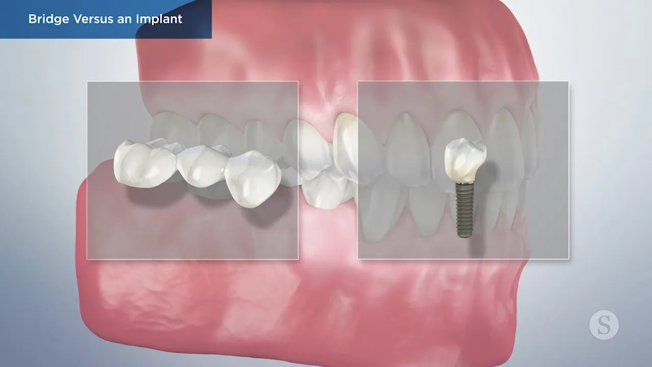Bridge Versus an Implant Video Thumbnail