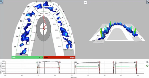 a scan from T-Scan which assists diagnosing TMJ disorder