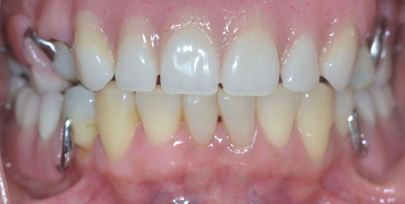 Before and After Case 4