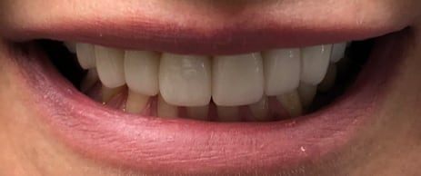 Before and After Case 6
