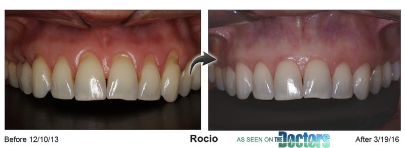Pinhole Surgical Technique™ case study
