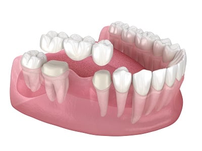 Illustration of a dental bridge being placed