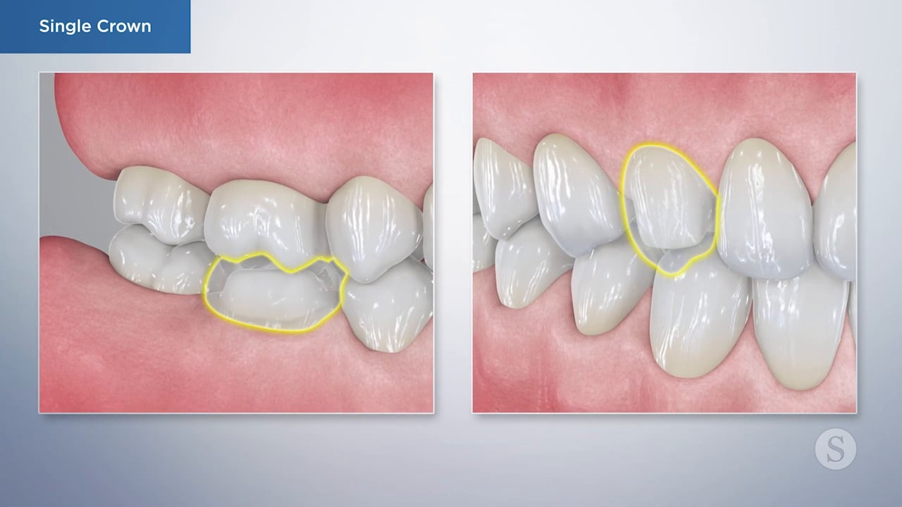 Dental Crowns Video Thumbnail